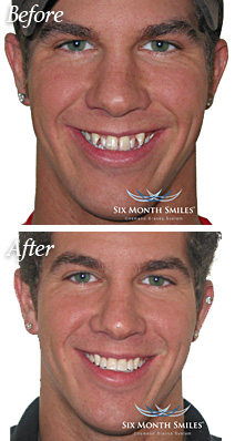 North Tonawanda Dentist Patient Before and After Six Month Smiles Treatment
